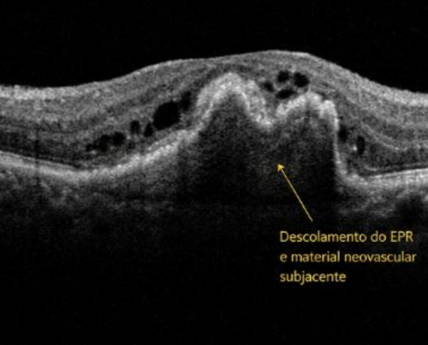 Degeneração macular