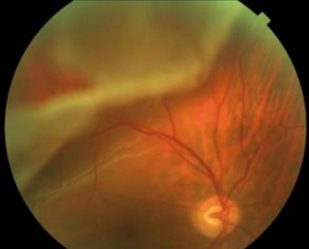 Descolamento de retina