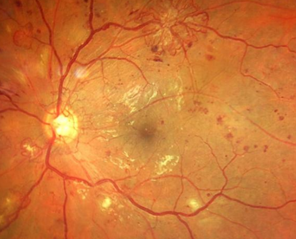 Retinopatia diabética